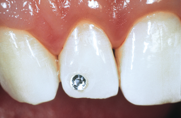 Skyce tandsmykker krystal 1,9 mm, 5 stk.