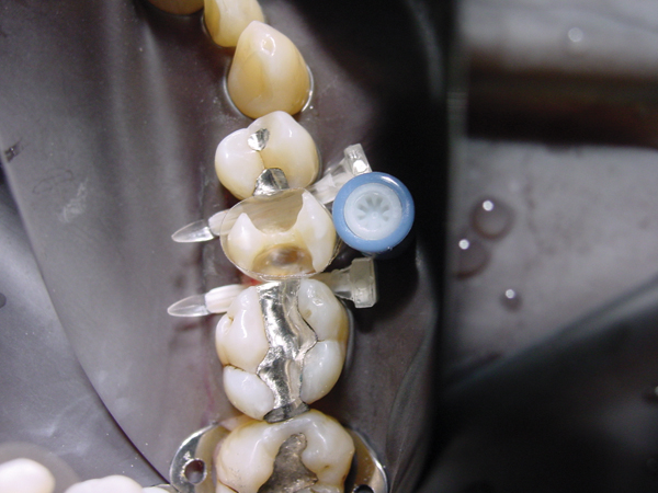 Luciwedge kiler nr. 770S x-små, 100 stk.